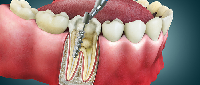 an animation image of a root canal
