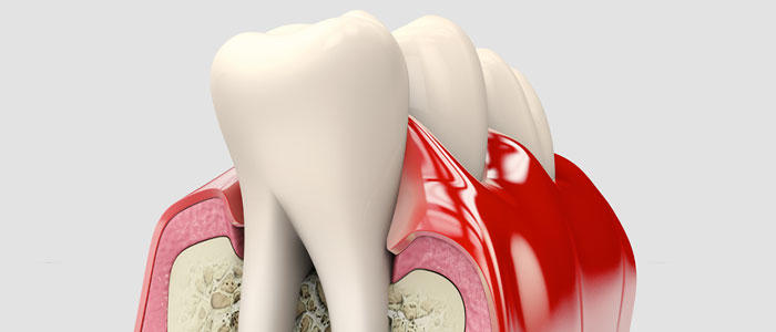 periodontal disease